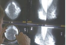 乳腺癌幸存者手术后可能不需要那么多乳房X光检查